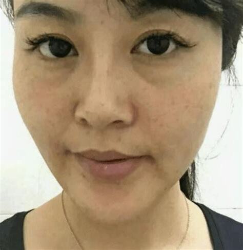 臉 斑